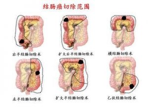 结肠癌的症状和治疗？